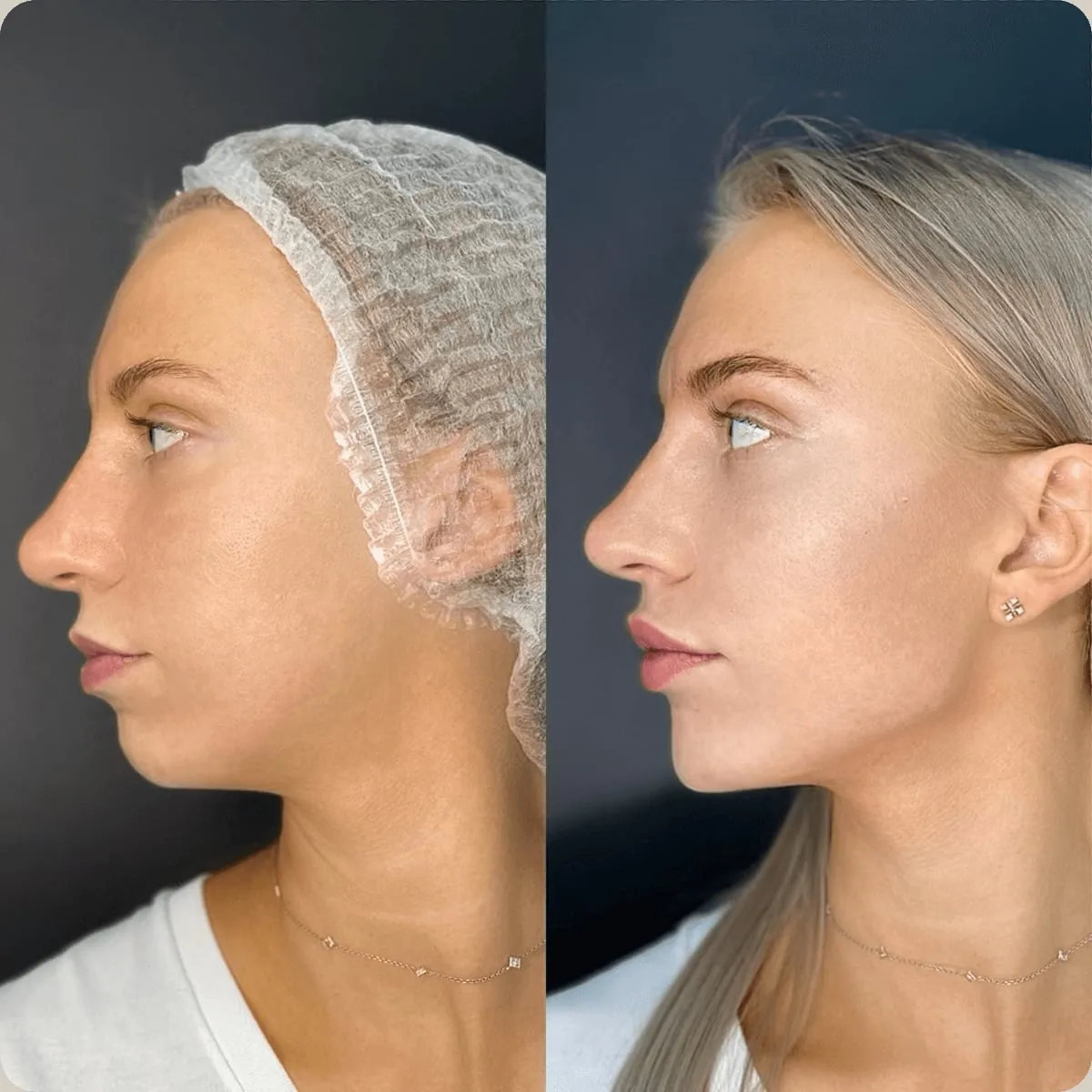 Before and after treatment, client 2