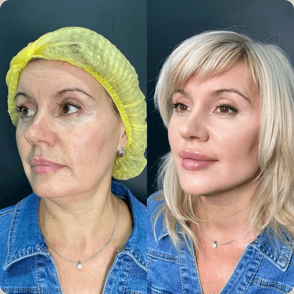 Before and after treatment, client 4