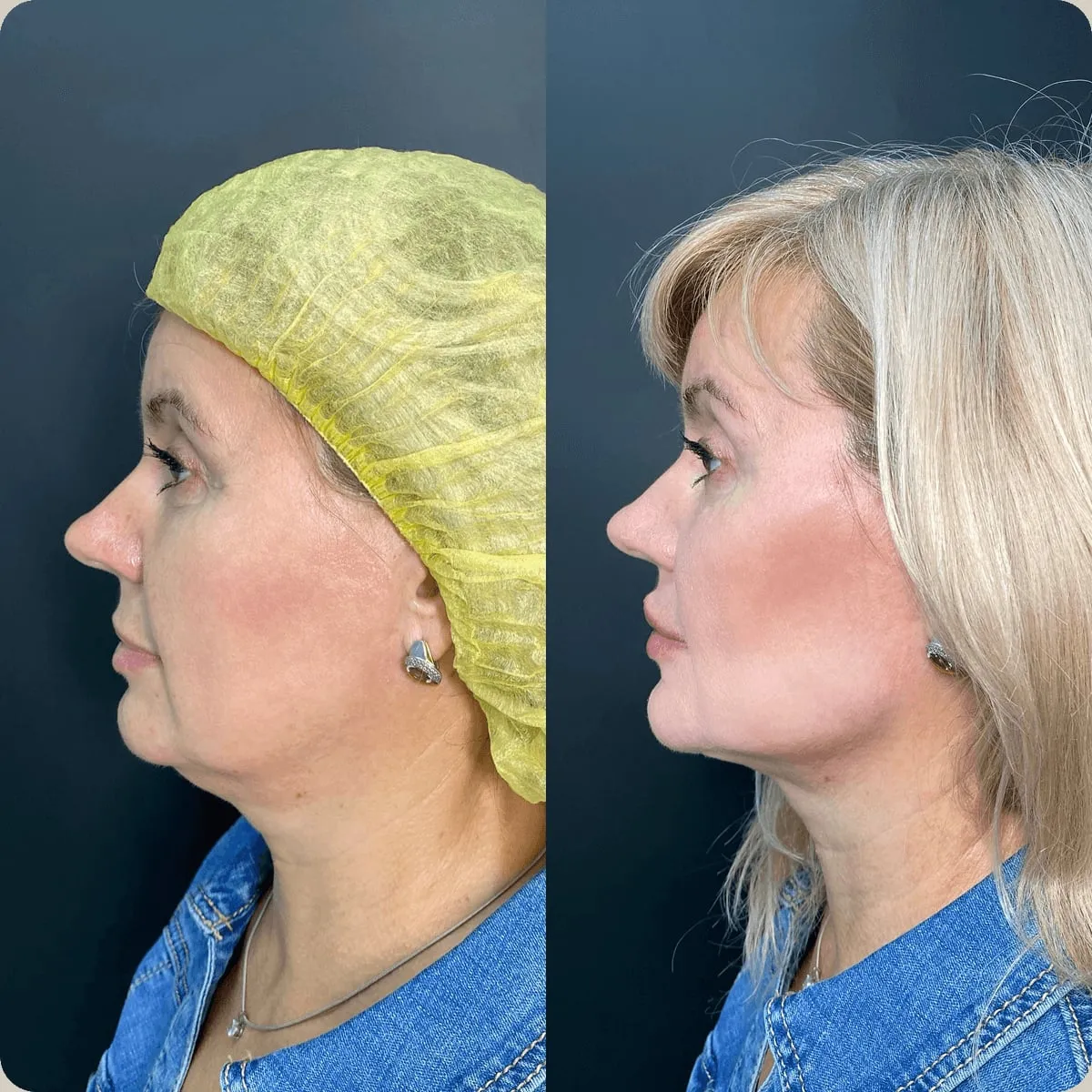 Before and after treatment, client 5