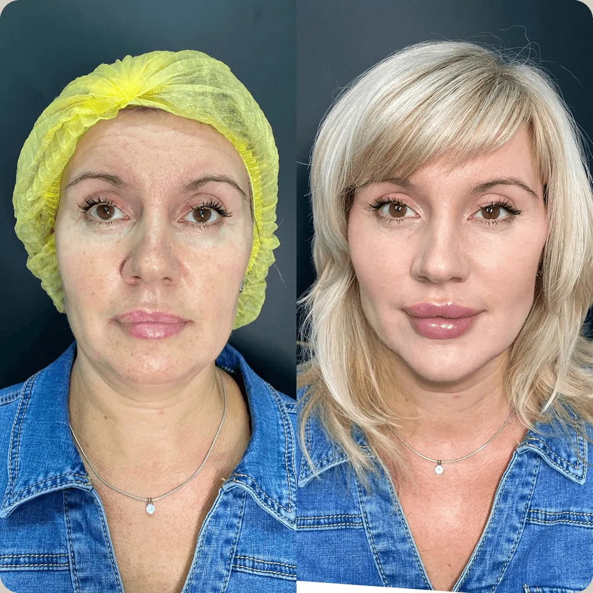 Before and after treatment, client 6