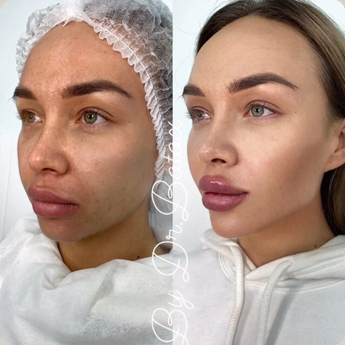 Before and after treatment, client 14