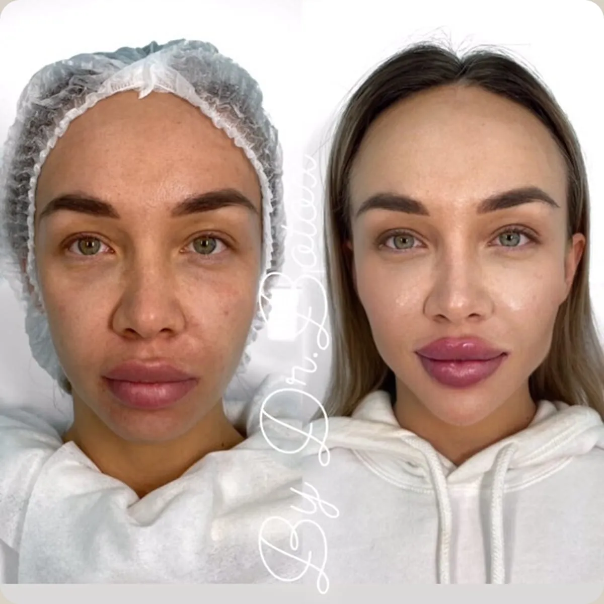 Before and after treatment, client 15